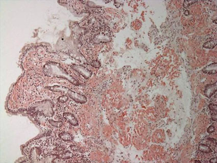 Amyloid