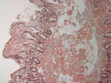 Amyloid Deposits