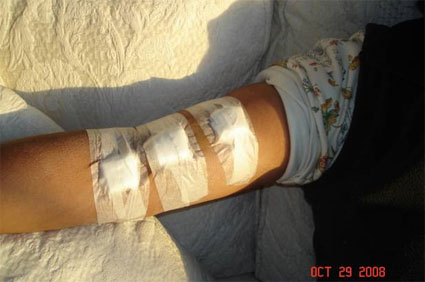 bandages