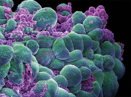 breast cancer cells