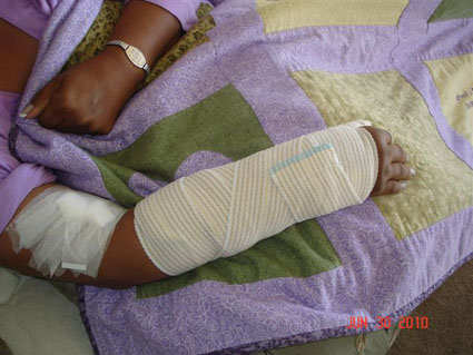 Broken Wrist