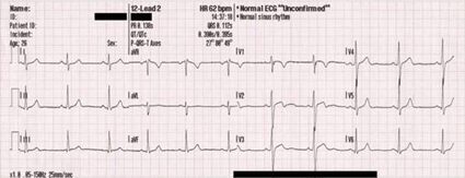ECG