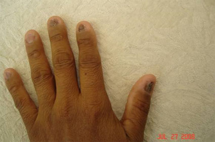 Fingernails