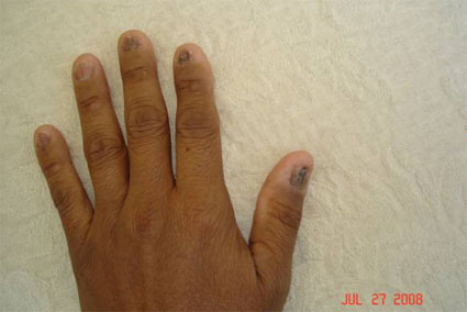 Fingernails
