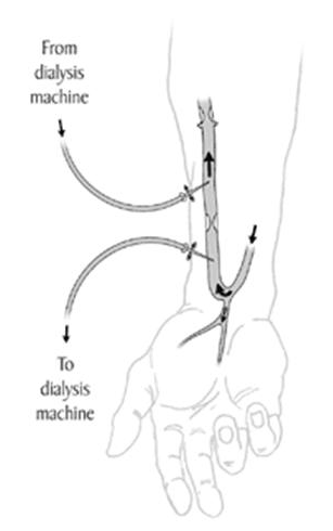 Fistula