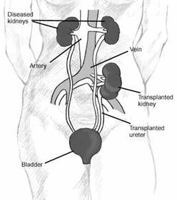kidney transplant