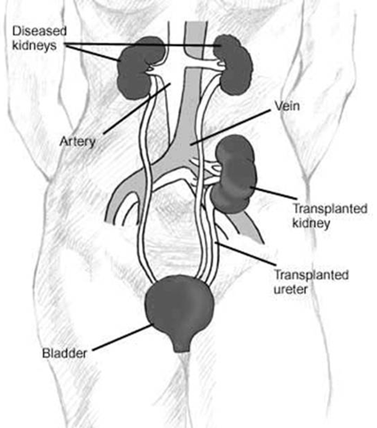 Kidney Transplant