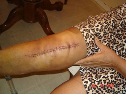 Carmen's Knee Replacement