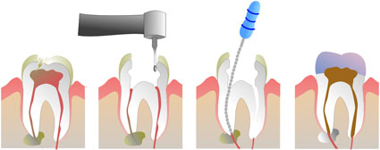 root canal