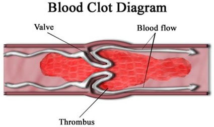 thrombus